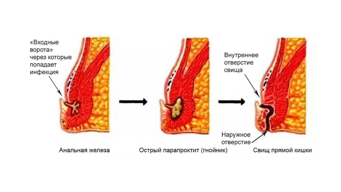 Свищ сфинктера. Подкожный парапроктит. Параректальный свищ симптомы.