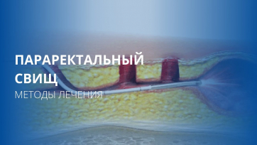 Embedded thumbnail for Параректальный Свищ