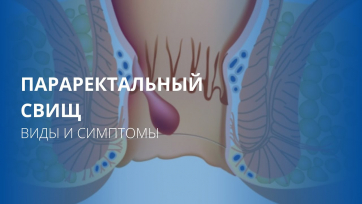 Embedded thumbnail for Параректальный Свищ